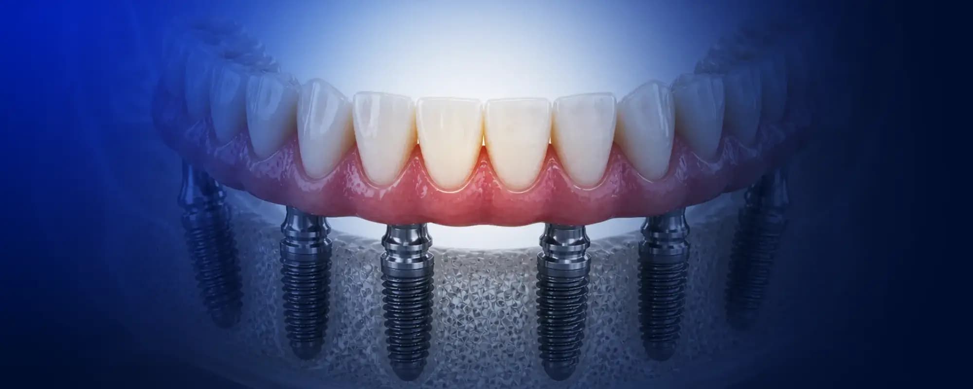 Dört implantla sabit dişlere dönüş