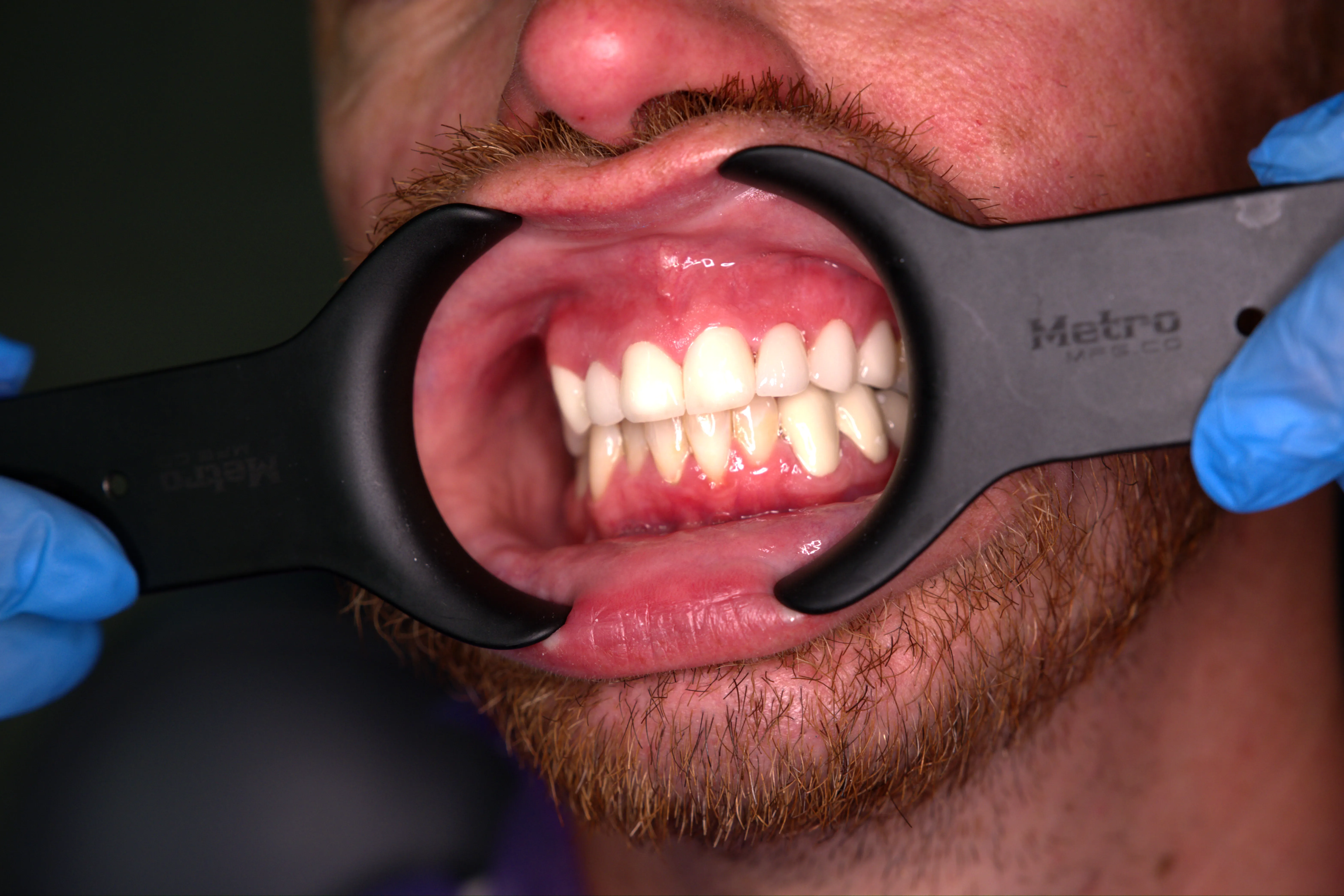 Zirconium Crown Intro